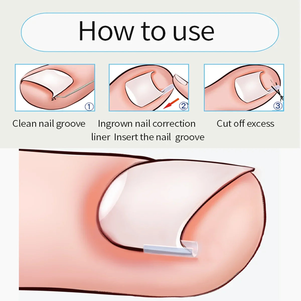 10pcs Ingrown Toenail Correction Tool Ingrown Toe Nail Treatment Elastic Patch Sticker Straightening Clip Brace Pedicure Tool